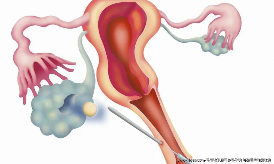 子宫腺肌症可以怀孕吗 补充营养注意休息